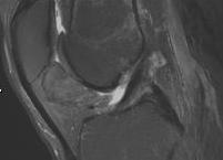 PVNS Knee MRI